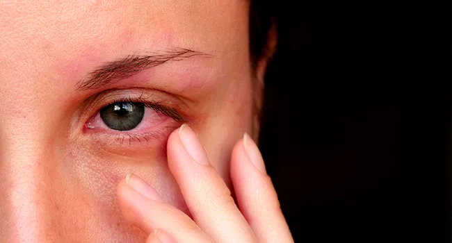 Watery Eyes (Epiphora): Causes, Home Remedies & Treatment