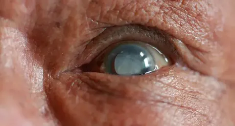 Important Things to Know Before Cataract Surgery