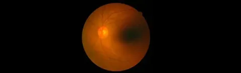 Retinal Detachment - A Flash is all that it takes!