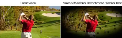 Retinal Detachment ? Cause &amp; Cure