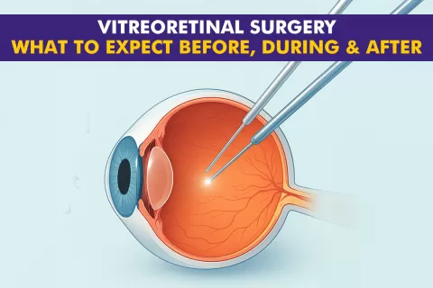 Vitrectomy Surgery: Procedure, Recovery and What to Expect