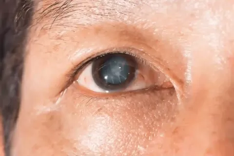 Cortical Cataract Explained: Causes, Symptoms & Treatment