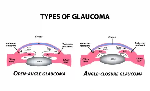 Major Types of Glaucoma (POAG, PACG & More)
