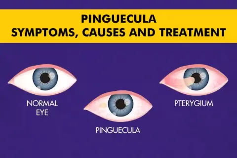 Pinguecula Eye Condition? - Symptoms, Causes and Treatment