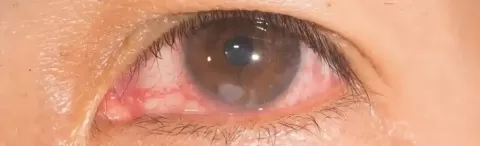 Contact Lens Infection: Symptoms, Risks & Corneal Ulcer