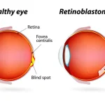 World Retinoblastoma Awareness