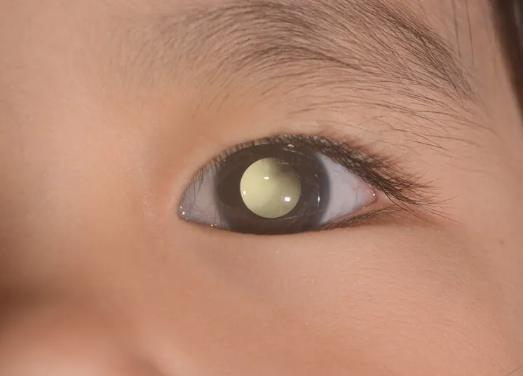 India has highest number of Retinoblastoma effected children