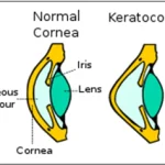 Understanding Keratoconus