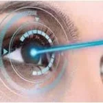 3 tips to minimize the recovery time after LASIK