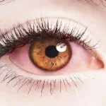 What Causes Bloodshot Eyes and How to Treat Red Eyes (Bloodshot Eyes)?