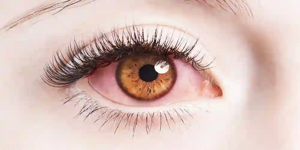 What Causes Bloodshot Eyes and How to Treat Red Eyes (Bloodshot Eyes)?