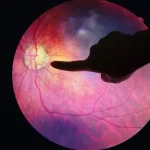 An Overview of Diabetic Retinopathy