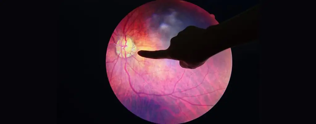 An Overview of Diabetic Retinopathy