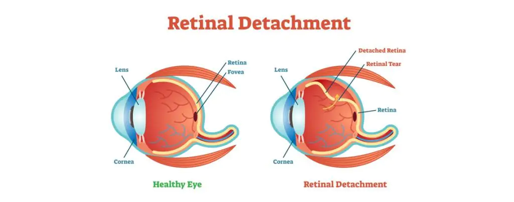 RETINAL DETACHMENT: CAUSES, TYPES, and DIAGNOSIS