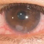 Story of wearing Contact Lenses and the risk of corneal ulcer