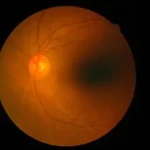 Retinal Detachment – A Flash is all that it takes!