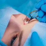 Why opt for SMILE procedure over traditional Lasik treatment