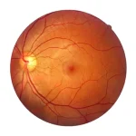 Retinal Detachment Causes