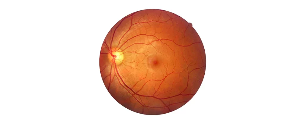 Retinal Detachment Causes