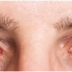 Could Fasting cause Dry Eyes?