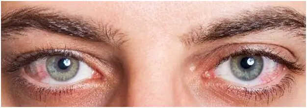 Could Fasting cause Dry Eyes?