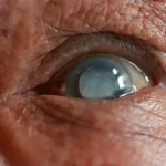 Cataract surgery – Things to Keep in Mind