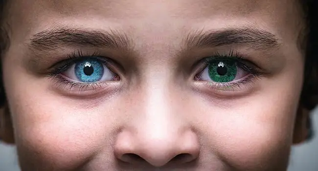 heterochromia.