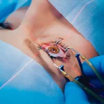 LASIK Surgery: Is it safe and should you get it?