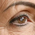 What to Do During a Glaucoma Attack?