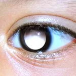 What Is Retinoblastoma And Can It Be Cured?