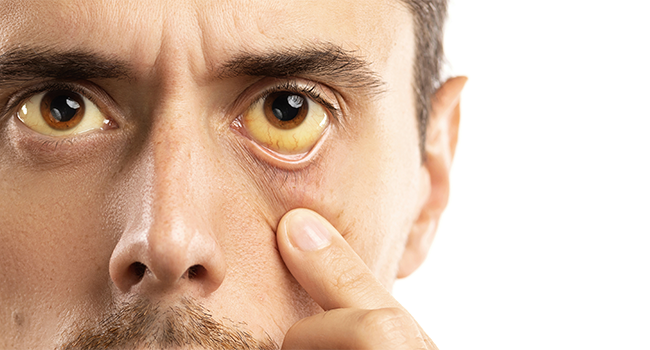 Yellow Eyes – Causes, Symptoms, And Treatment Of Conjunctival Icterus! -  Centre For Sight