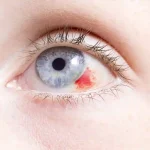 What are the complications of the scratched cornea?