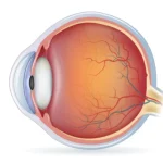 What-are-the-significant-causes-of-retina-tears