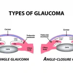 Types of Glaucoma: Primary Glaucoma & Secondary Glaucoma