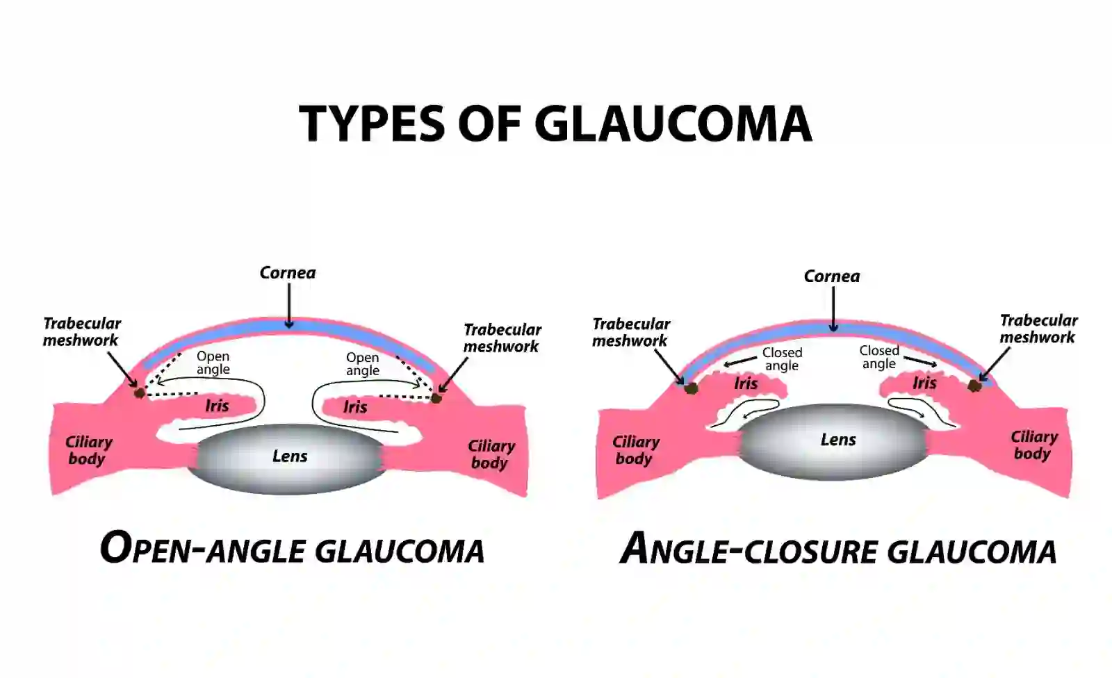 Types of Glaucoma: Primary Glaucoma & Secondary Glaucoma