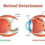 Retinal-Detachment