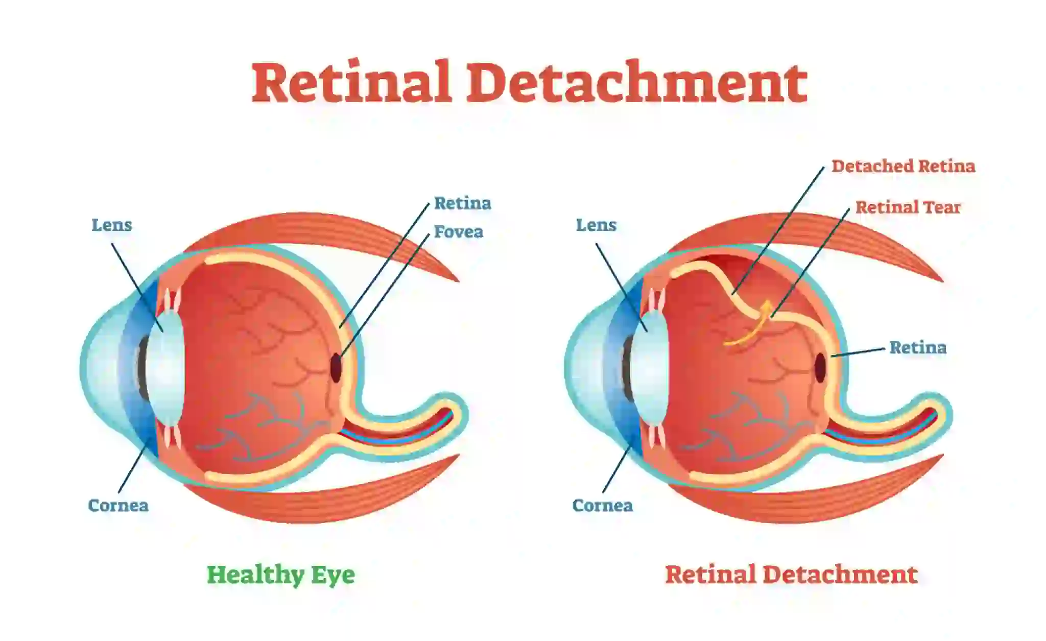 Retinal-Detachment