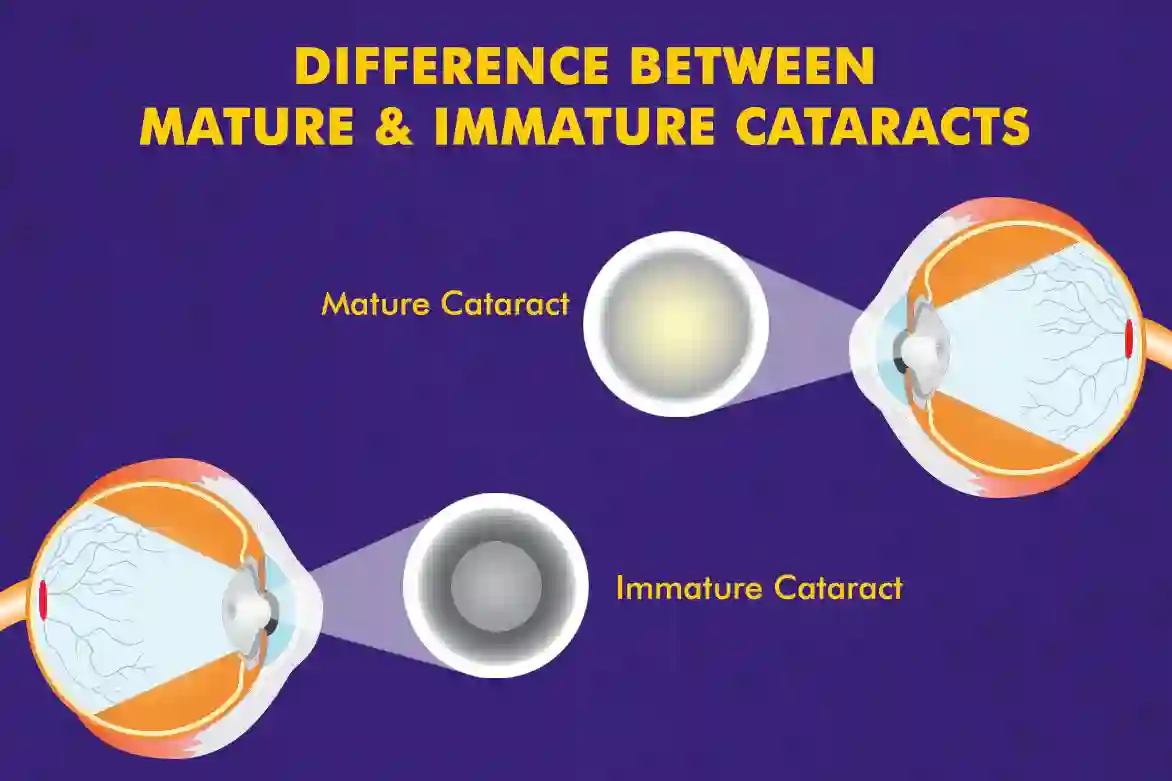 Difference-between-mature-and-immature-cataract.