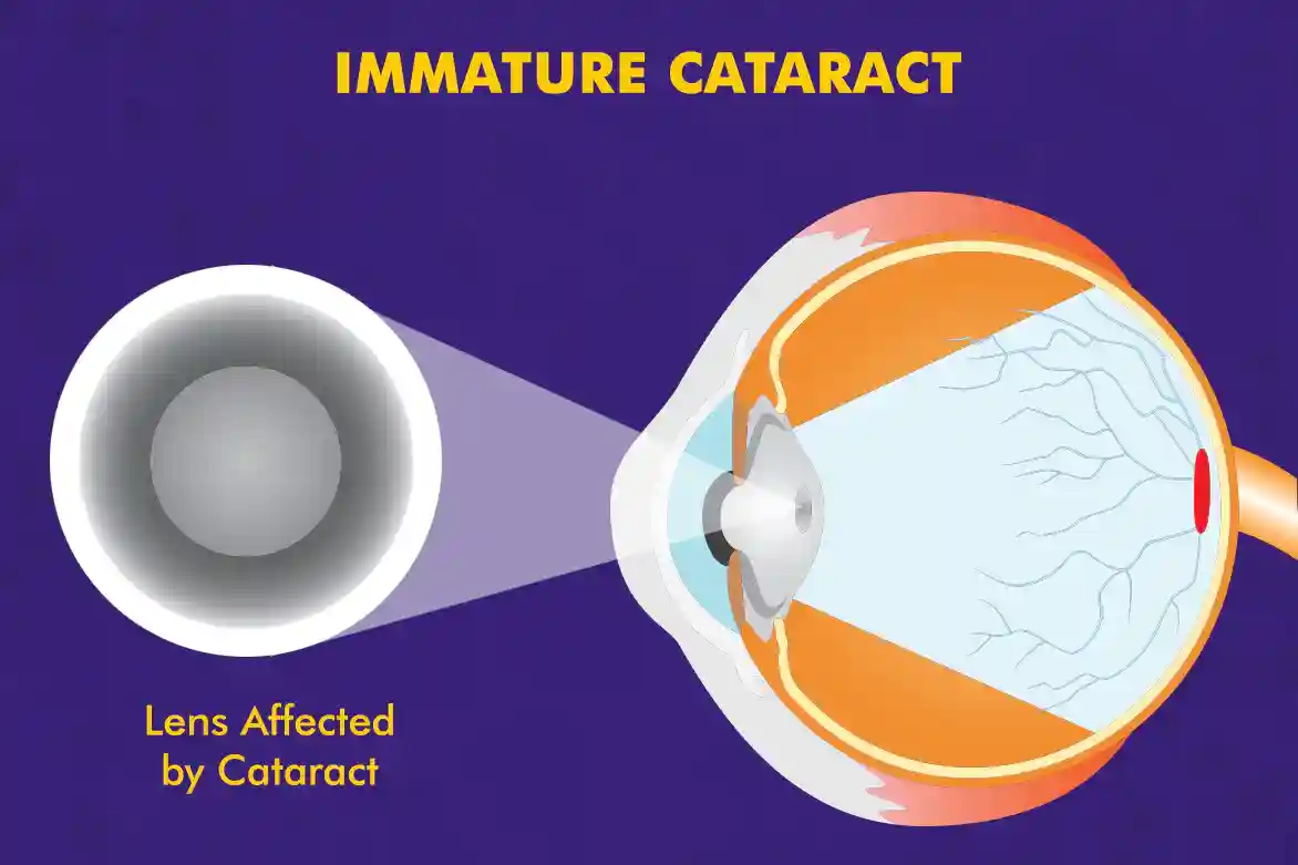 Immature-Cataract.