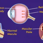 Macular-Hole