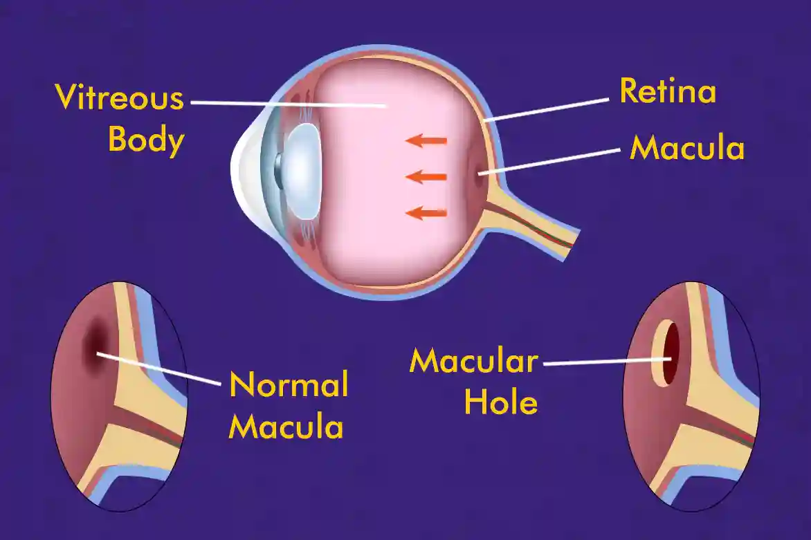 Macular-Hole