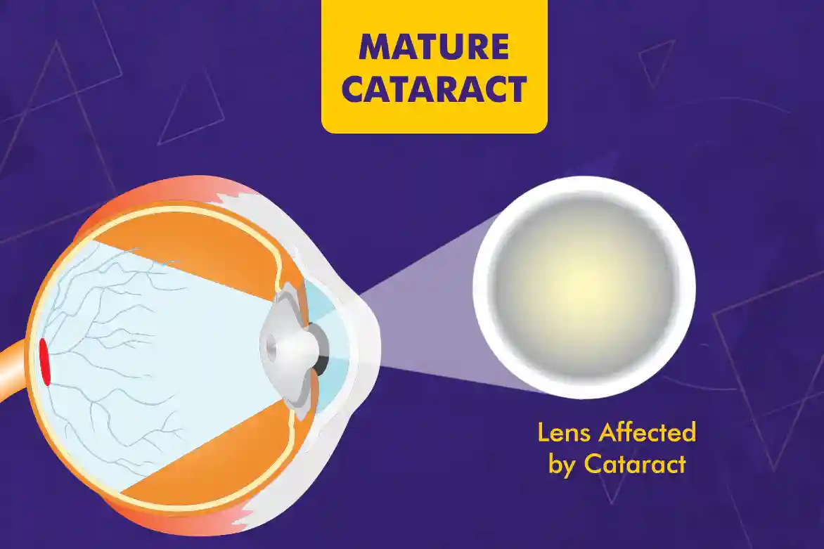 Mature-Cataract.