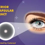 posterior subcapsular cataract and its effects on vision