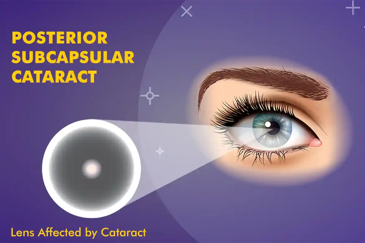 posterior subcapsular cataract and its effects on vision