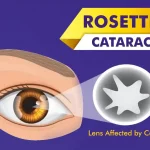 Rosette-Cataract