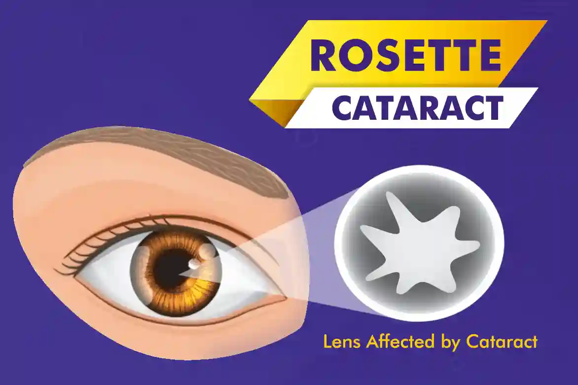 Rosette-Cataract