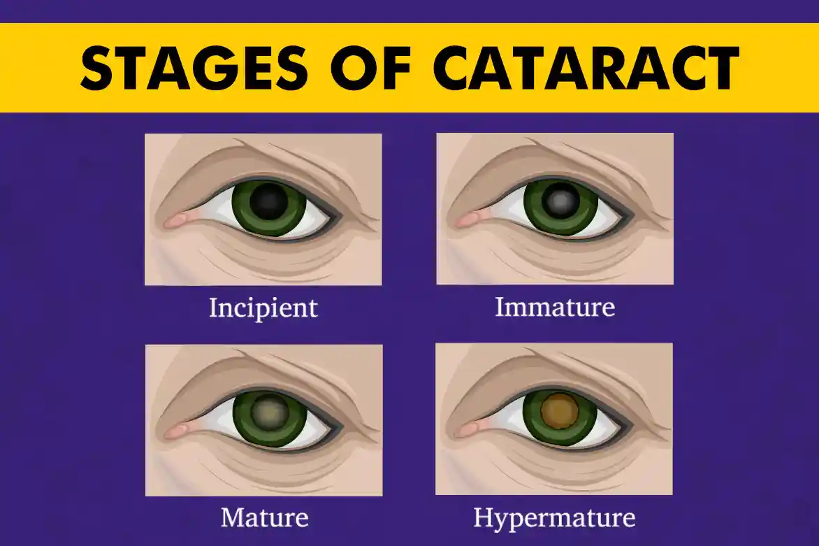 Cataract Grading.