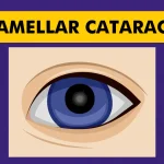 Lamellar-Cataract