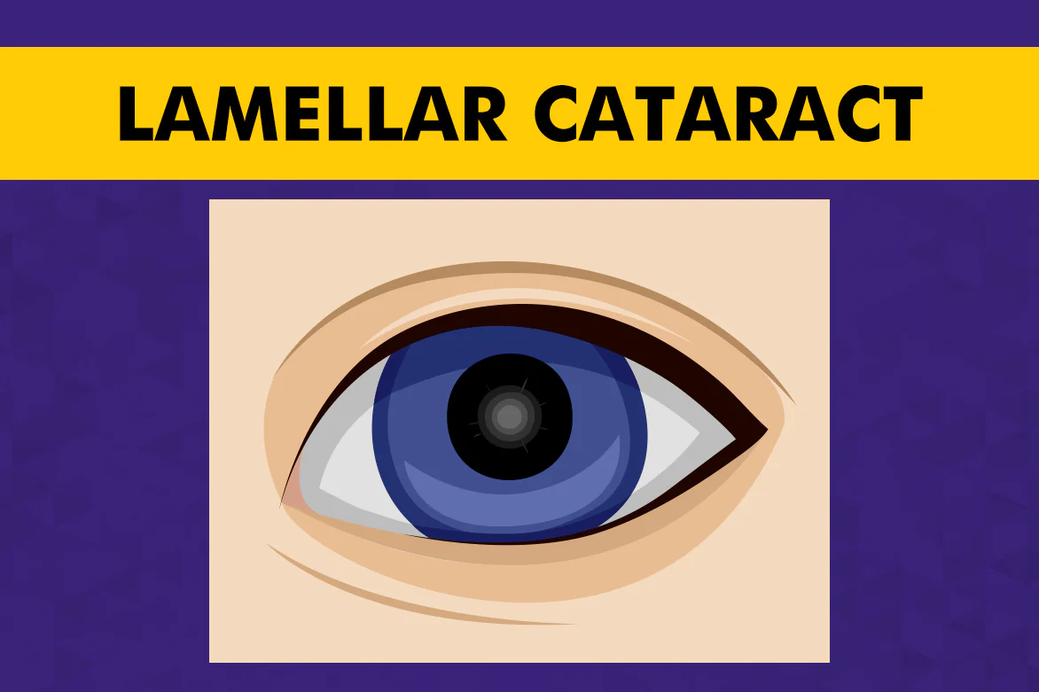 Lamellar-Cataract