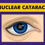 Nuclear-Cataract